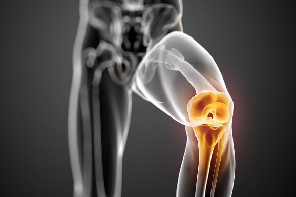 Arthrose van het kniegewricht