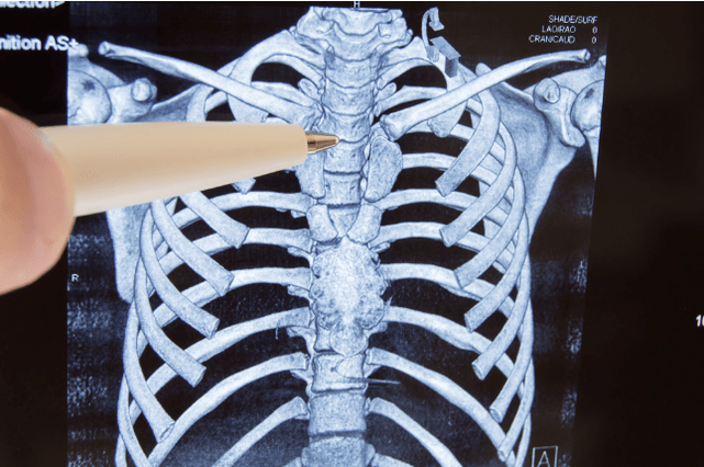osteochondrose