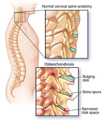 cervicale osteochondrose