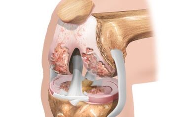 Arthrose van het kniegewricht