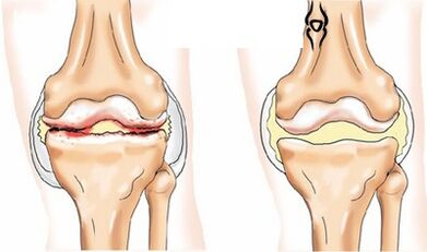 Bilaterale gonarthrose
