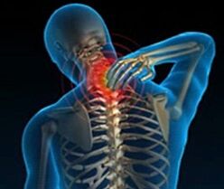 osteochondrose van de cervicale wervelkolom