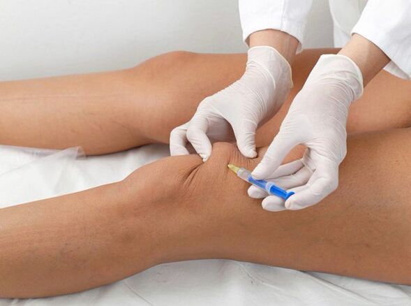 intra-articulaire injectie voor knieartrose