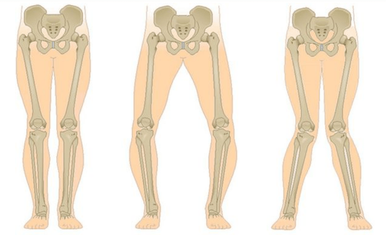 complicaties van knieartrose