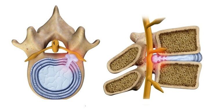 Tussenwervelschijfhernia – uitsteeksel van de schijfkern in het wervelkanaal